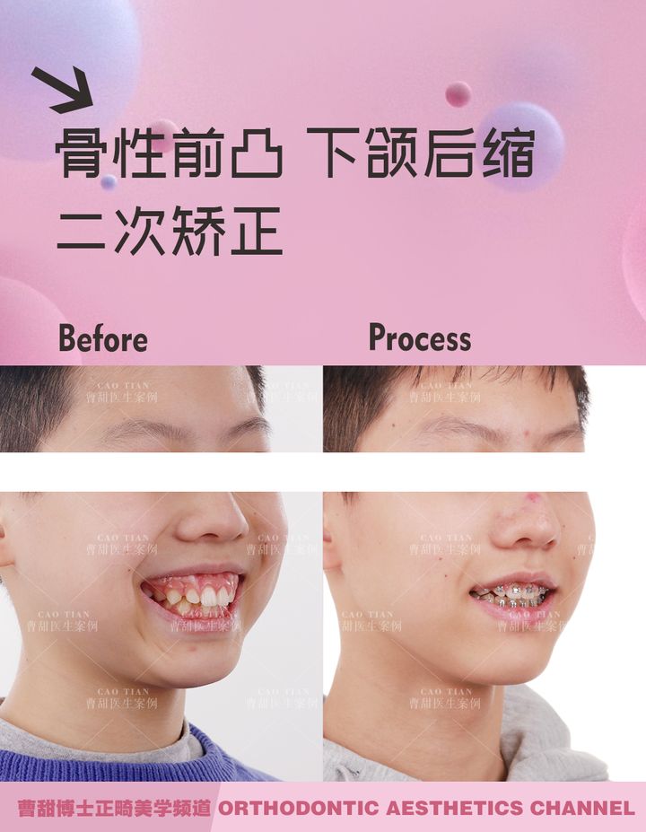 儿童反颌矫正完嘴凸,儿童下颌后缩嘴凸矫正需要多久