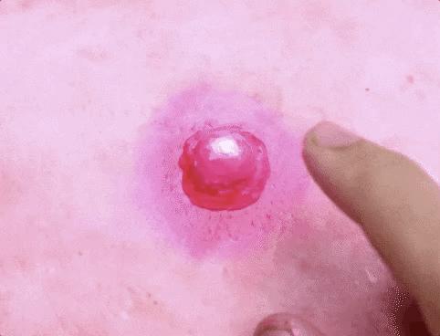 为什么二十岁开始疯狂长痘,一个人反反复复长痘什么原因