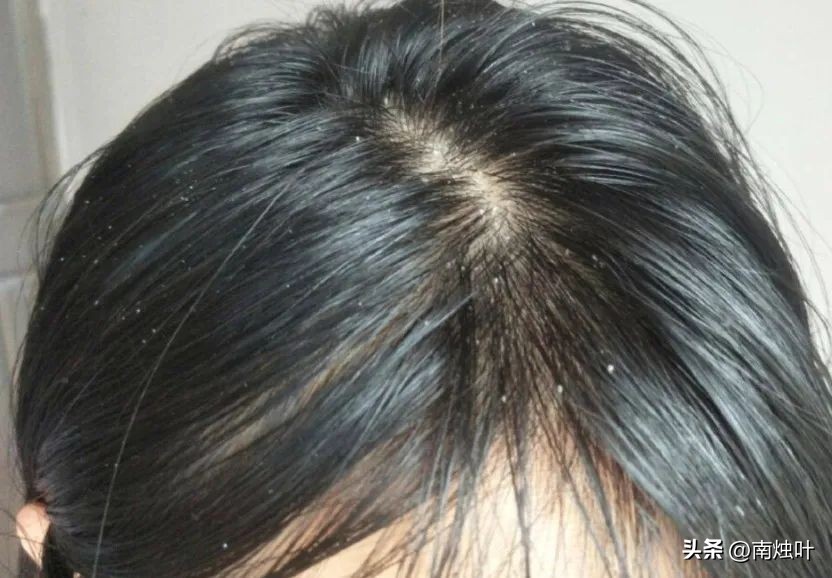 夏天头发毛躁怎么护发,头发干枯毛躁用什么保湿护发免洗