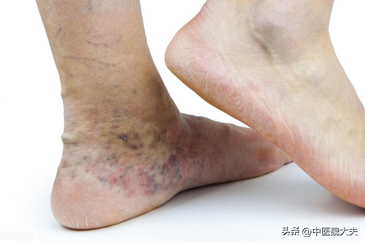 腿上有很多细小的血丝是怎么回事,腿上出现红血丝是什么原因引起的