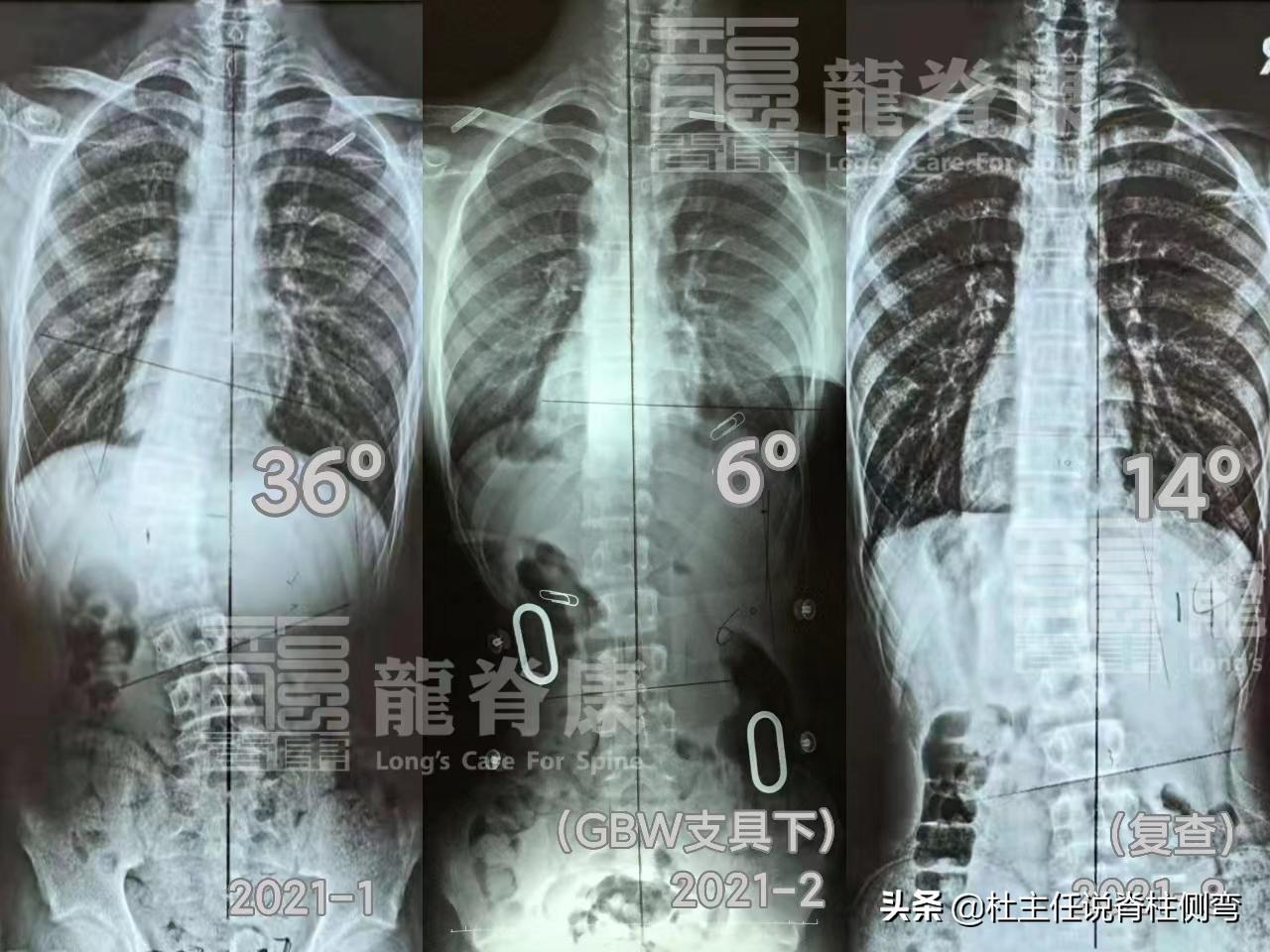 11至14岁青少年更易患脊柱侧弯,脊柱侧弯多少度会出现剃刀背