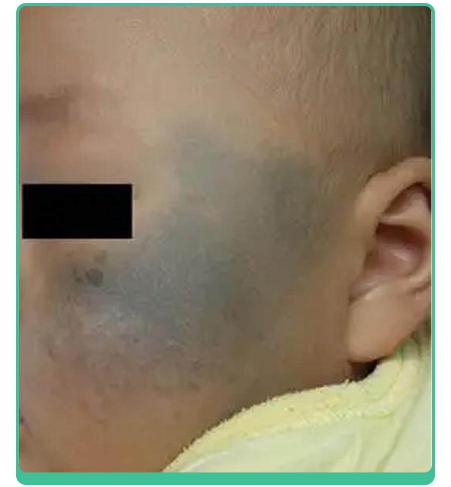 宝宝手上长胎记，一查竟是血管瘤！医生：这5种胎记要早处理