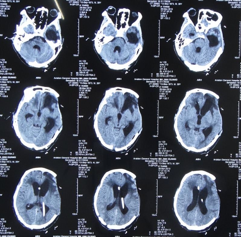 脑外伤开颅手术后继发癫痫,开颅术后颅内感染