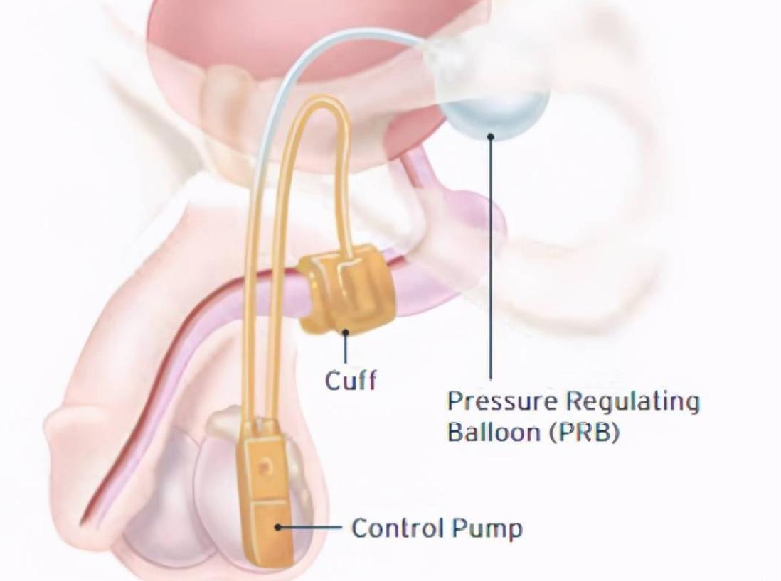 一位单身女青年的疑问：同房时，男人射精和尿尿会同时发生吗？