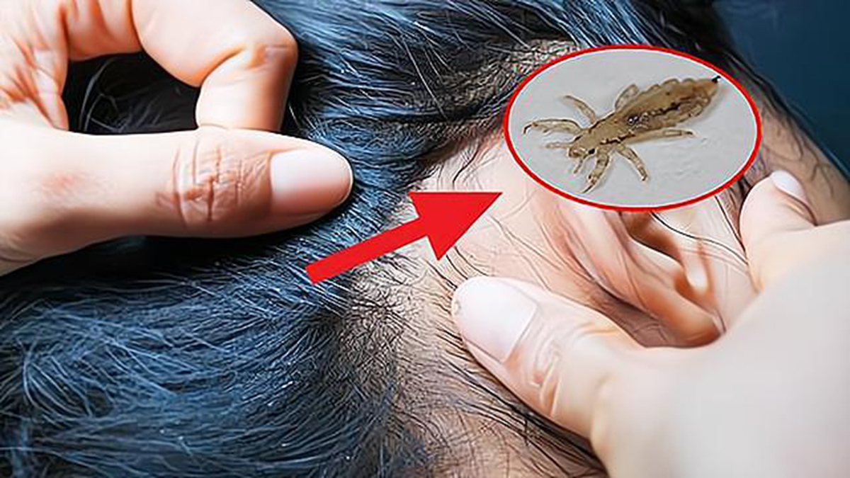 虱子在头上有什么危害,虱子对人体有哪些害处