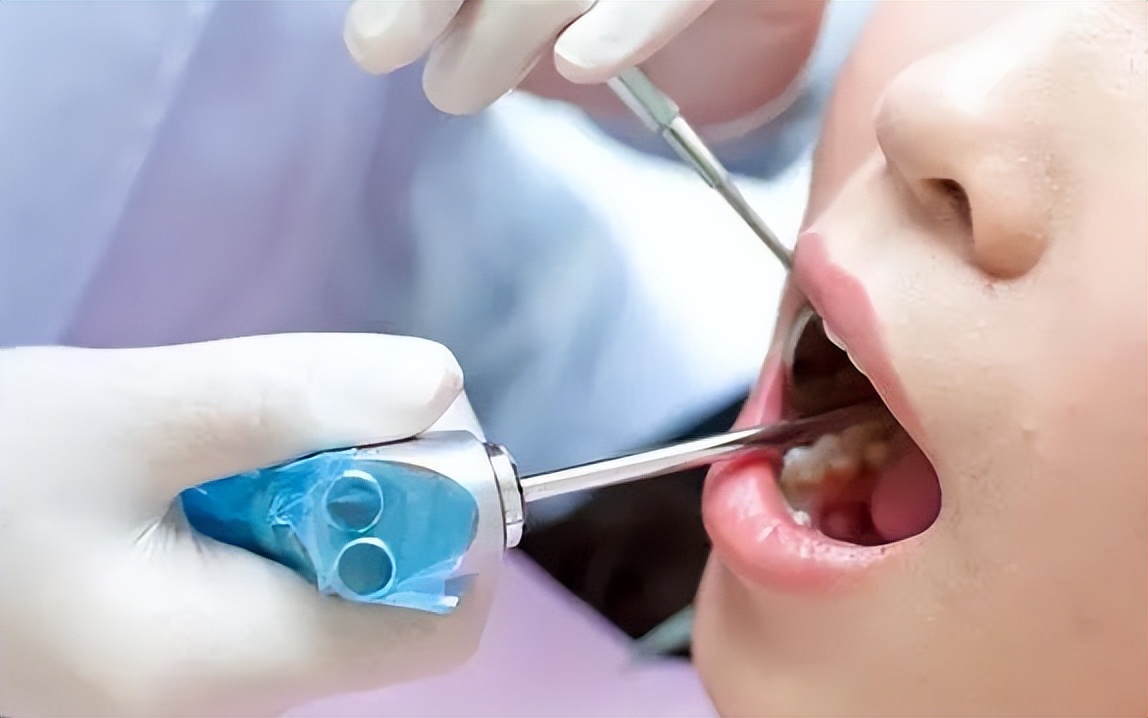 洗牙会伤害牙齿吗该不该洗牙,深度洗牙对牙齿有伤害吗