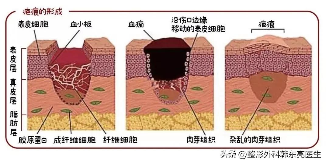 脸部疤痕最好的修复方法,修复凹陷疤痕的最好方法
