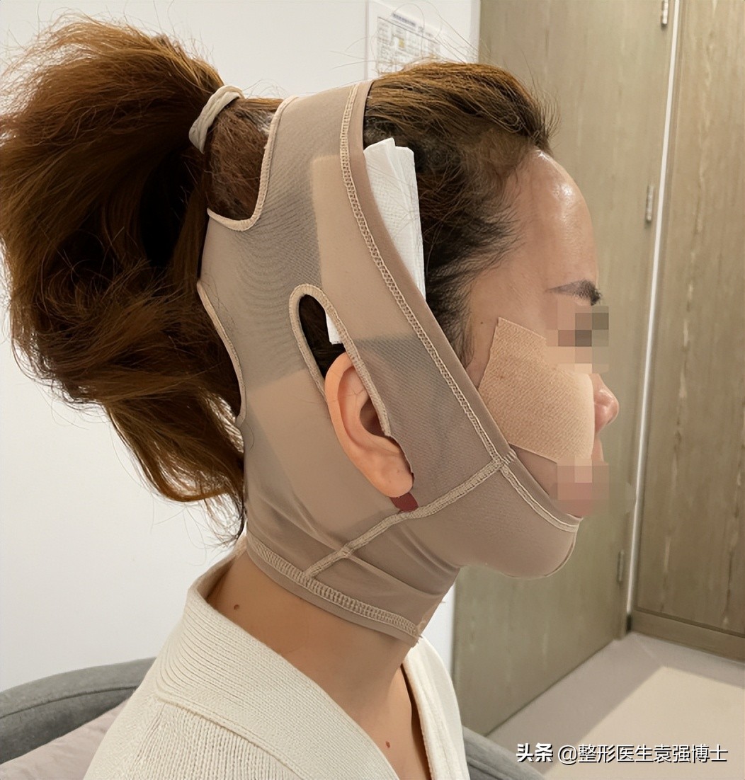 拉皮术后无美颜对比图,40岁拉皮术后恢复视频