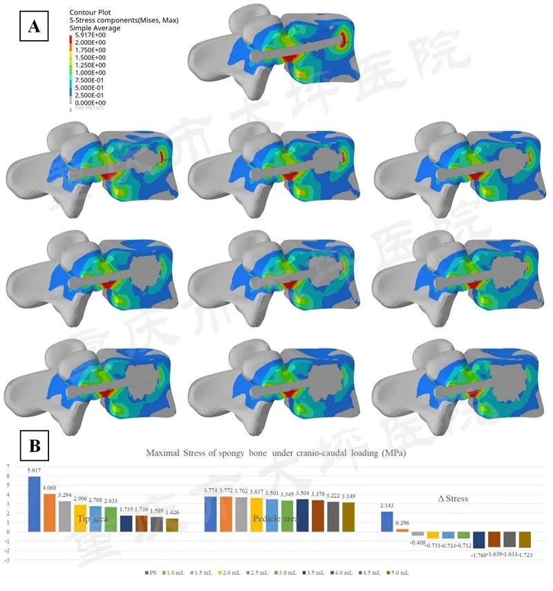 骨水泥螺钉治疗腰椎骨折,骨水泥钉技术
