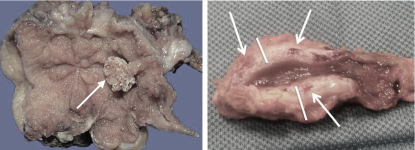 胆囊多发息肉样病变8mm*6mm,胆囊息肉病变0.6严重吗能喝酒吗