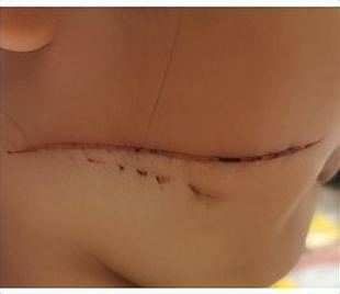 最难愈合的疤痕,无法治愈的疤痕