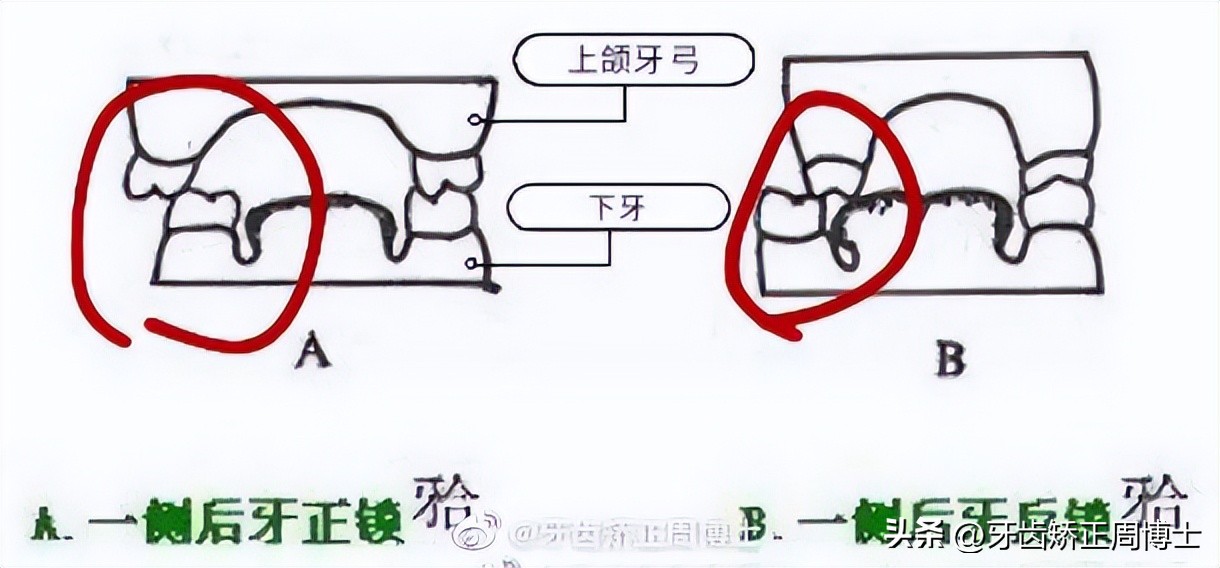 早期矫正下颌往前伸怎么纠正,改善正畸后锁颌方法
