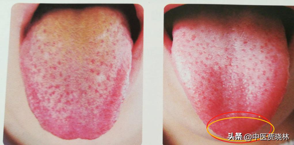 舌尖疼心火旺,舌头疼是肝火还是胃火舌头溃疡