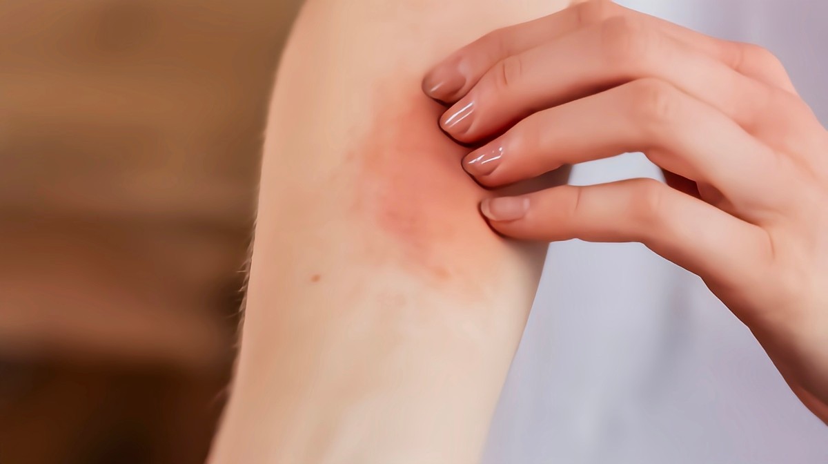 女子腹部痒，医生用镊子夹出16只阴虱！原来阴虱有4个传播途径