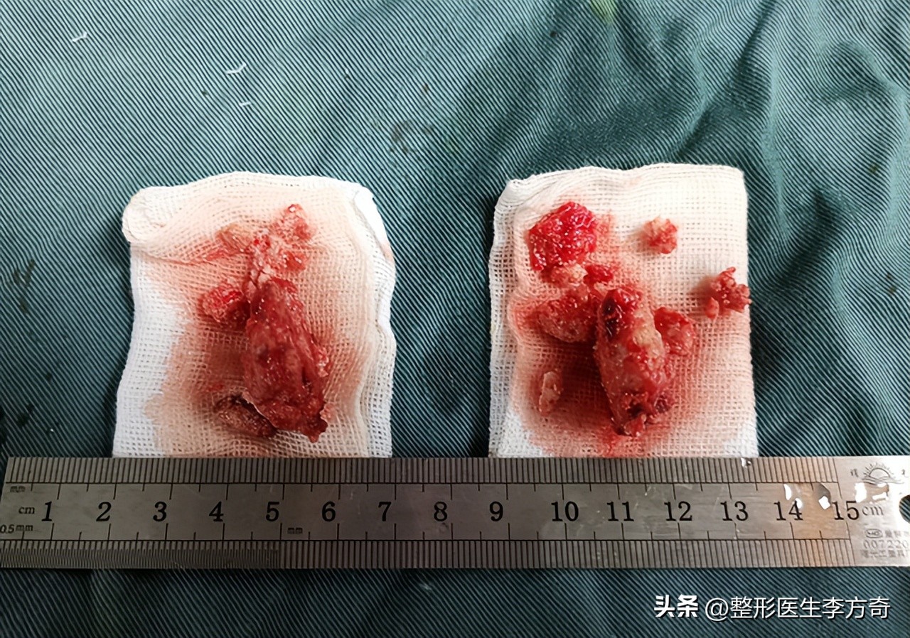 为什么骨粉填充不建议做,面部注射骨粉危害