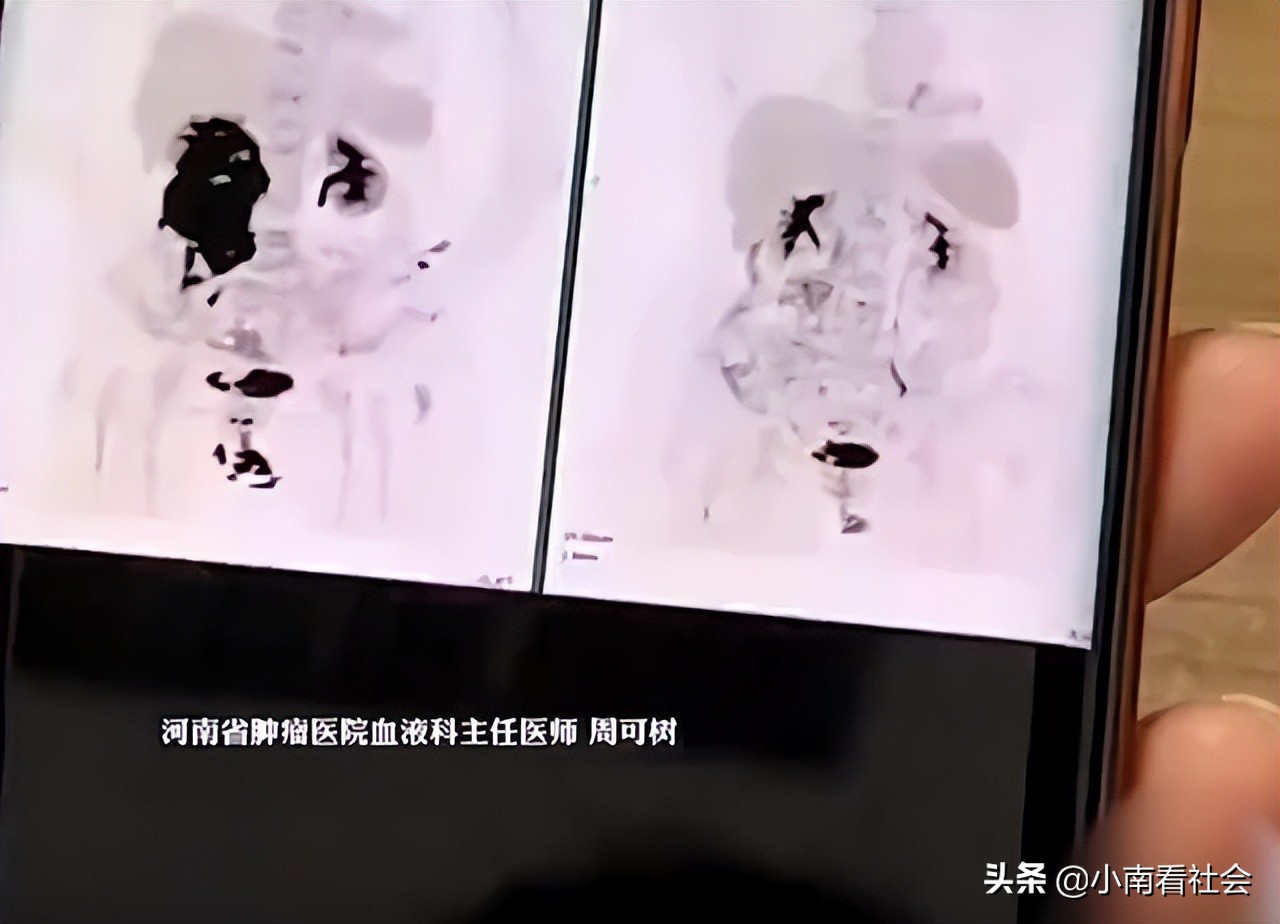 癌细胞扩散后的治愈奇迹,国内一针治愈癌细胞