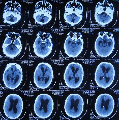 脑外伤后硬膜下积液颅骨修补,颅骨修复手术失败导致脑积水