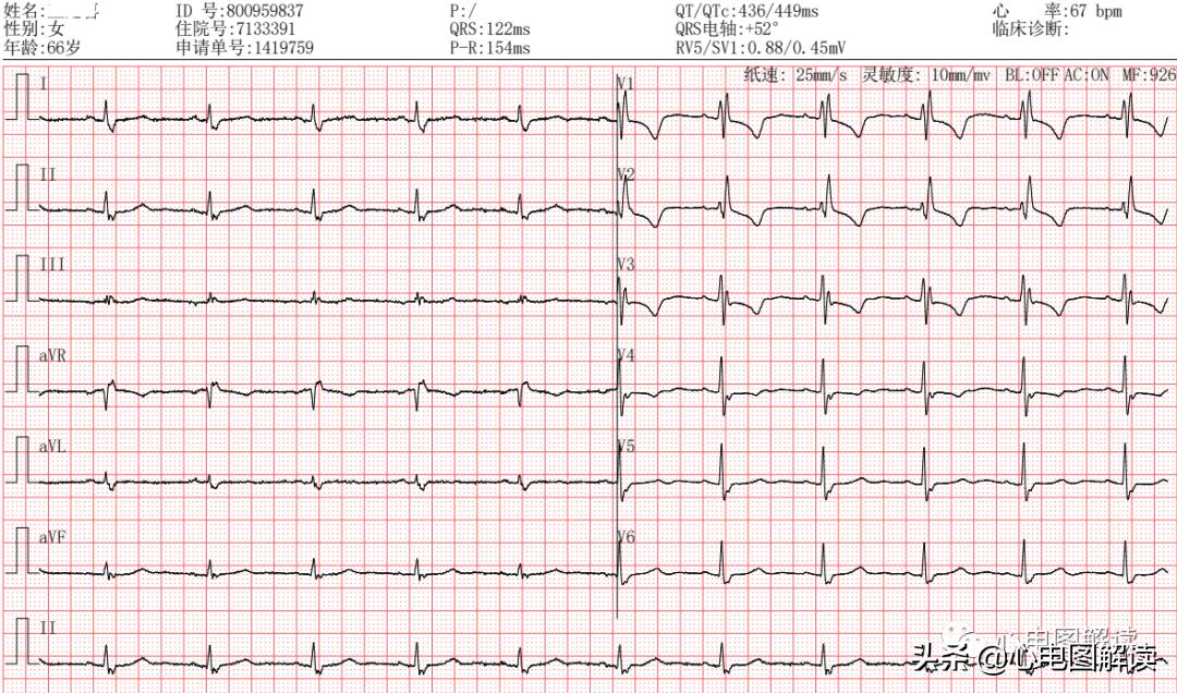 右束支阻滞qrs波形图解,右束支传导阻滞继发性st段改变