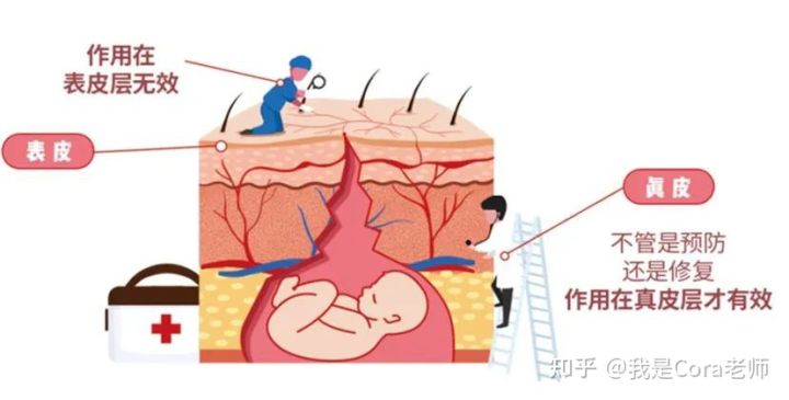 妊娠纹用什么方法可以修复,妊娠纹可以修复吗
