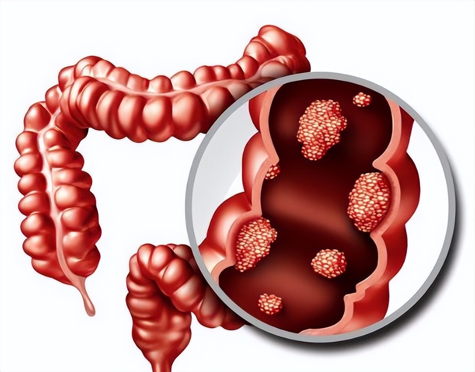 大便前面干硬后面软正常吗,大便前面硬后面软什么问题呢