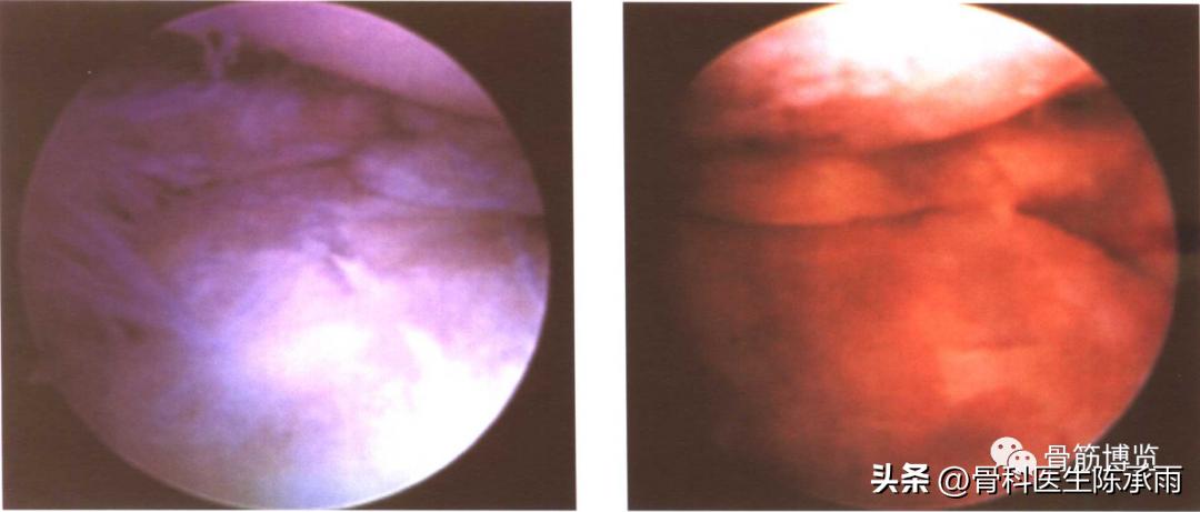 盘状半月板撕裂一级,半月板层裂愈合概率