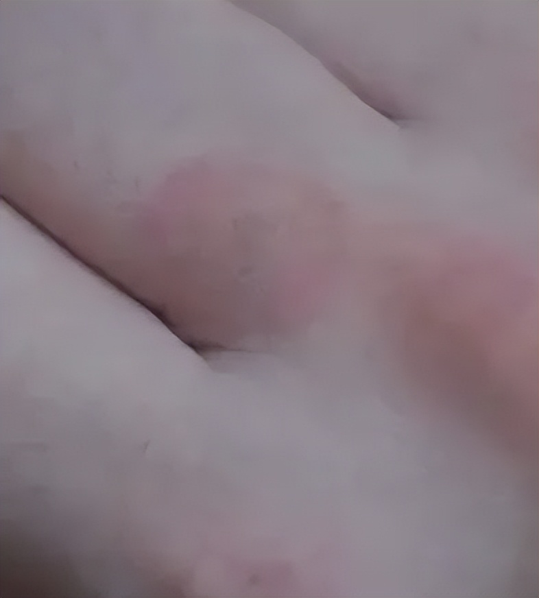 猫咪得了猫癣人怎么办,猫咪猫癣怎么治好得快