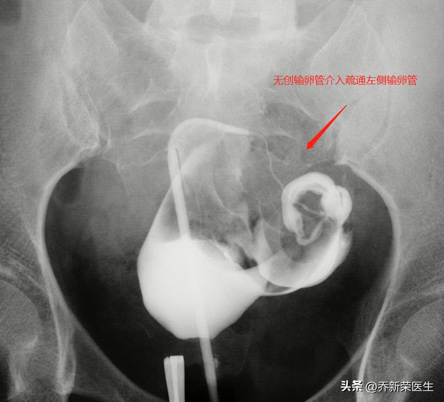 输卵管健康警报：通而不畅的真相及应对策略