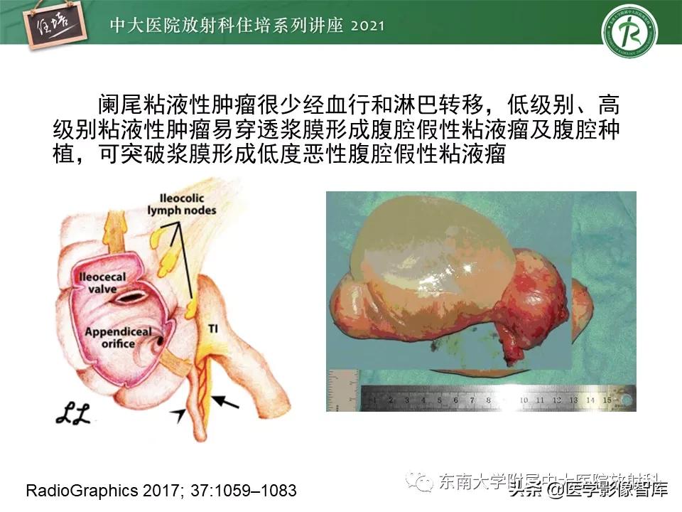 卵巢浆液性肿瘤的肉眼及镜下特征,卵巢原发性粘液性囊腺瘤