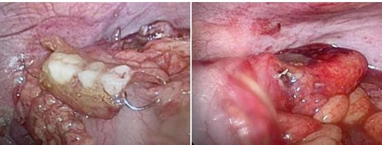 医疗||假牙“咬”穿结肠，市中心医院专家妙手摘除“夺命金属套”