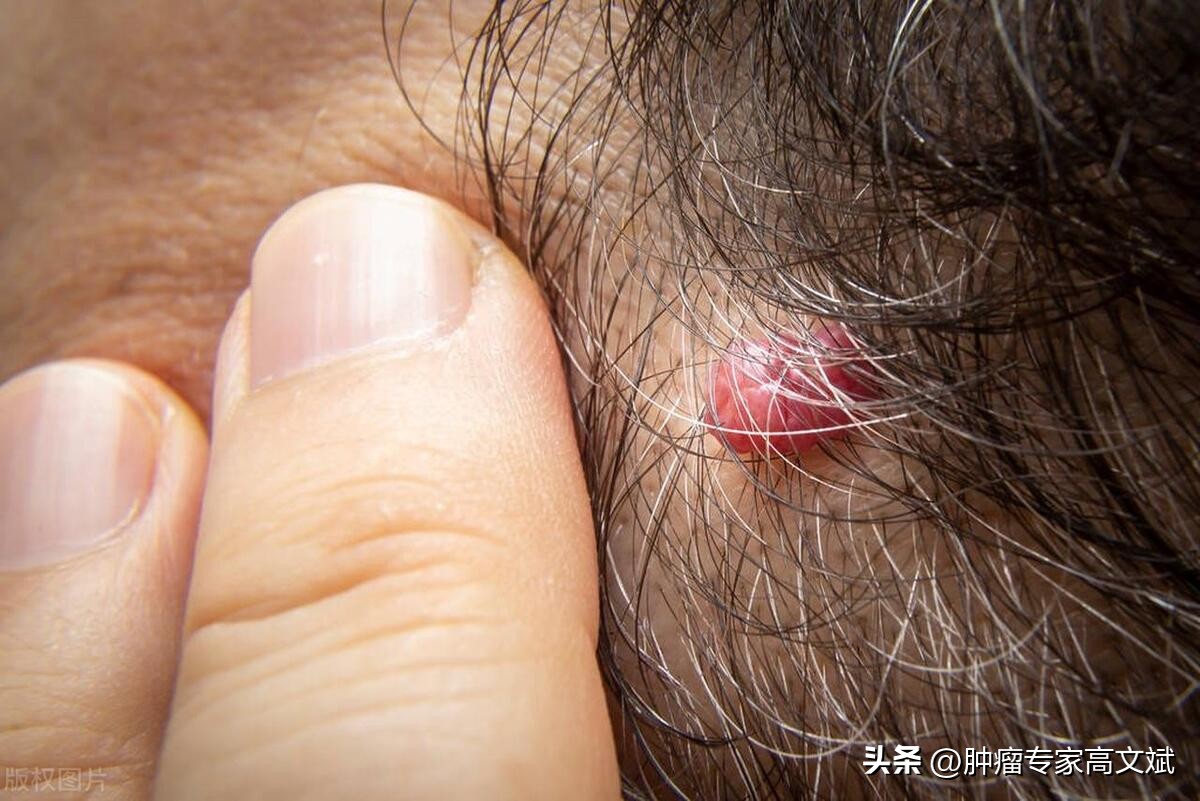 来说说你有哪些痣,说说你有几处纹身