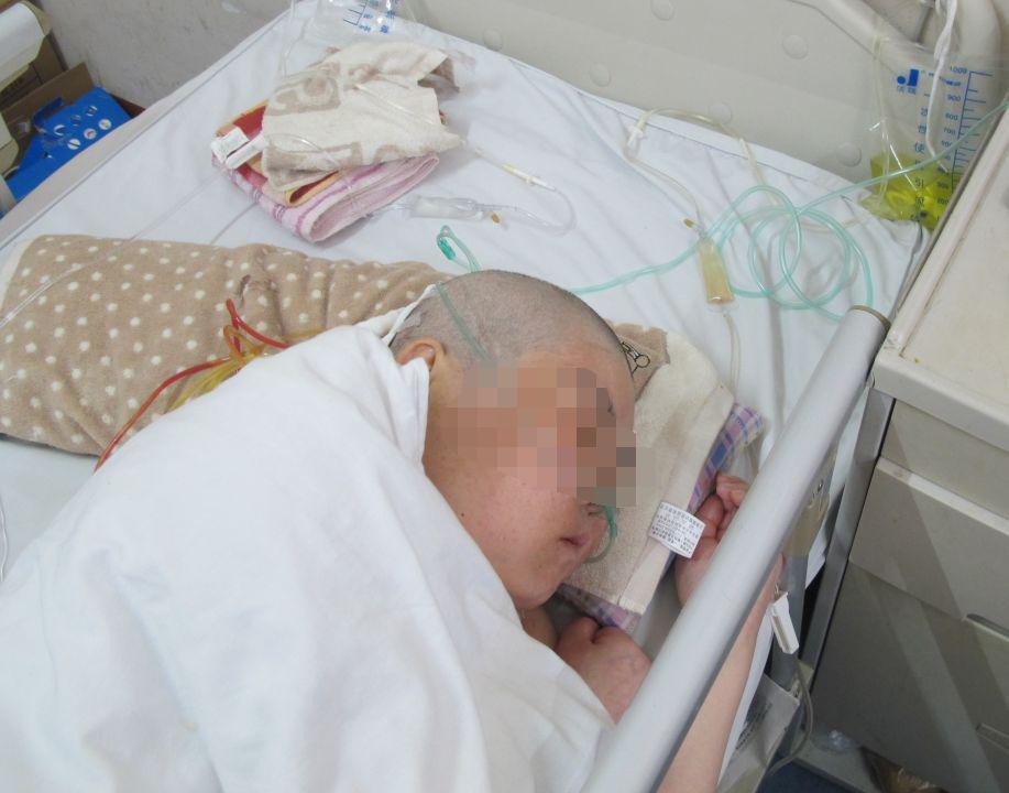 听神经瘤出现脑积水和出血,听神经瘤手术后颅压高症状