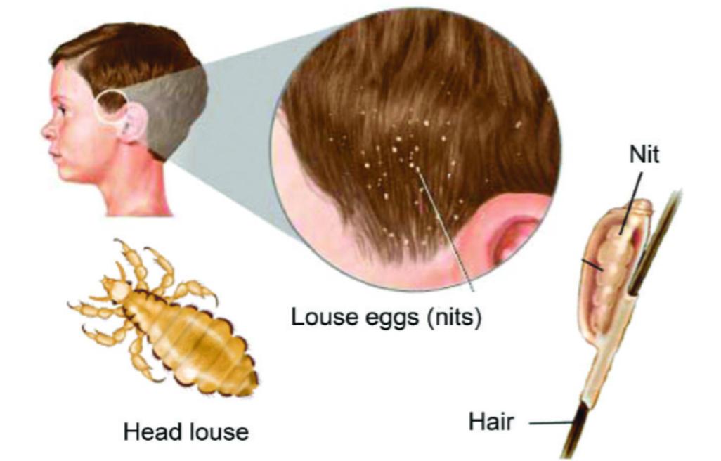 蜱虫比虱子厉害吗,怎么判断蜱虫和虱子