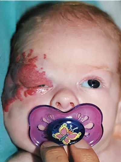 治疗婴幼儿血管瘤的特效药物——盐酸普萘洛尔口服液上市