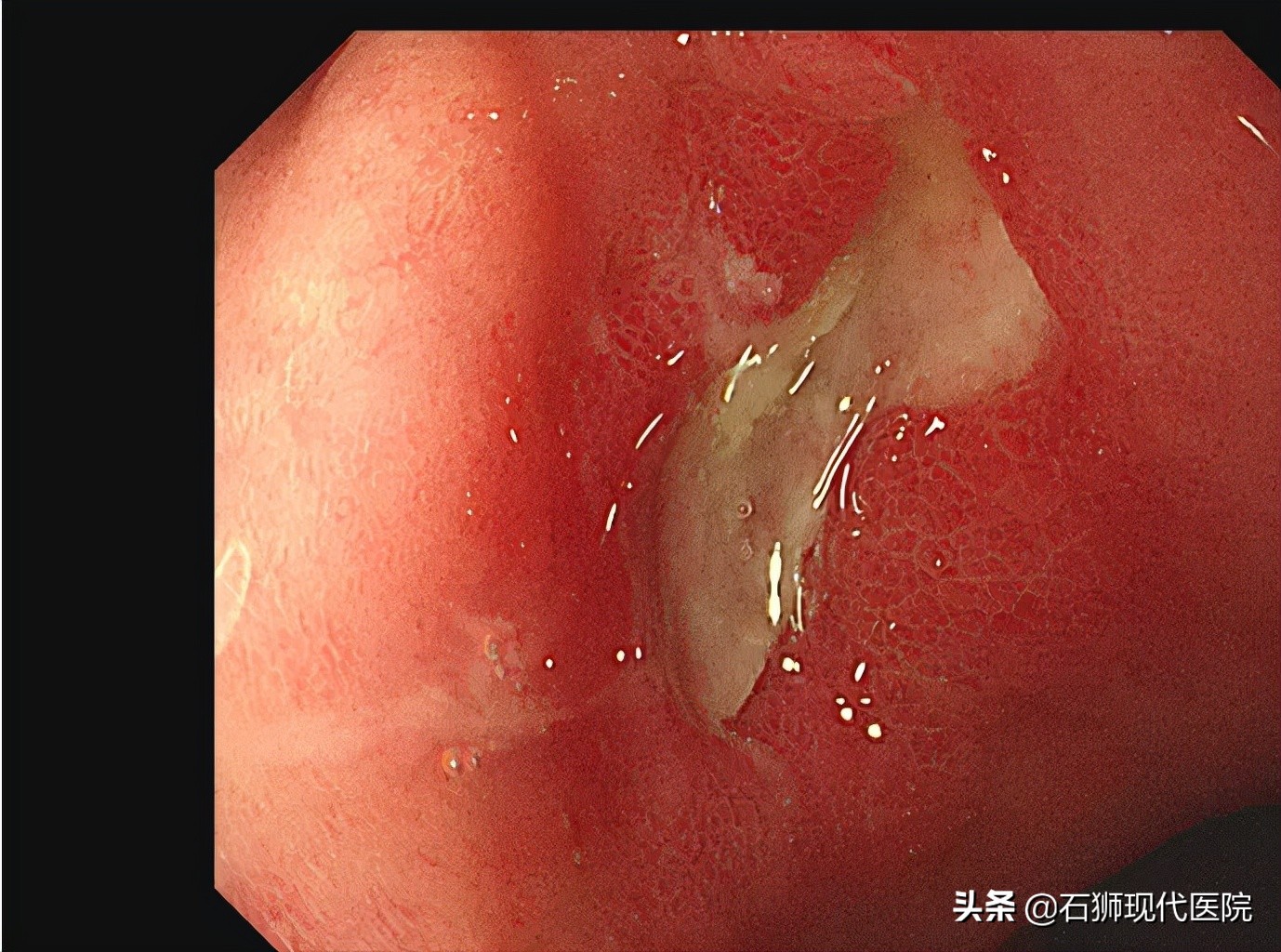 石狮医院有无痛胃镜吗,有哪些人不合适做胃镜