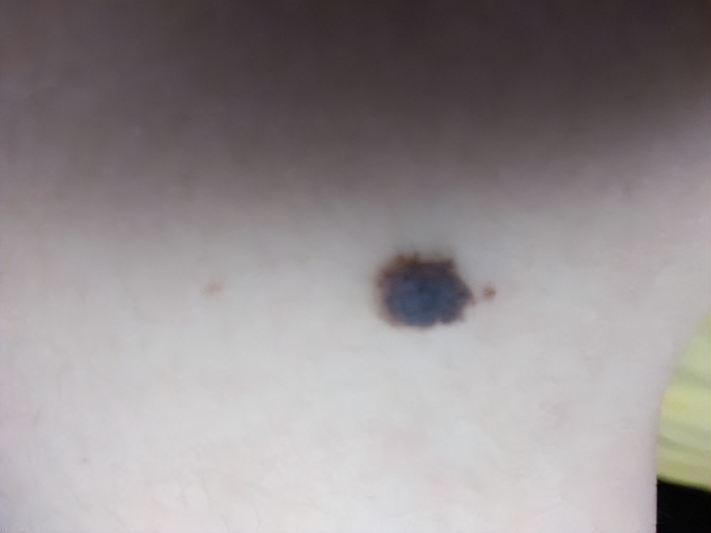 身体部位有黑痣和红痣是什么,痣黑如漆与深黑死痣区别