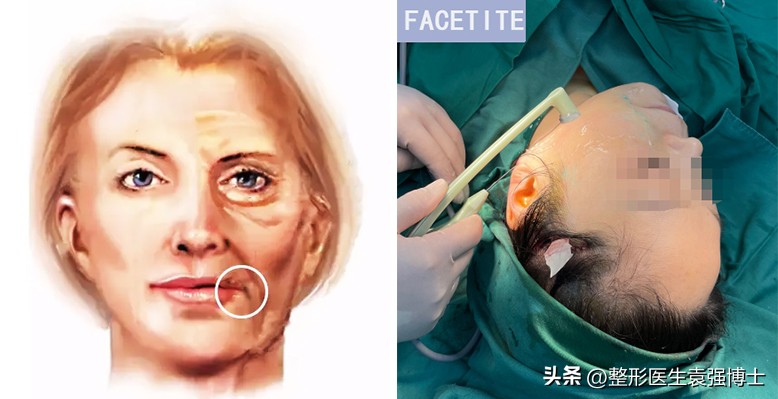 口角囊袋下垂怎么办,口角囊袋去掉会不会变松弛