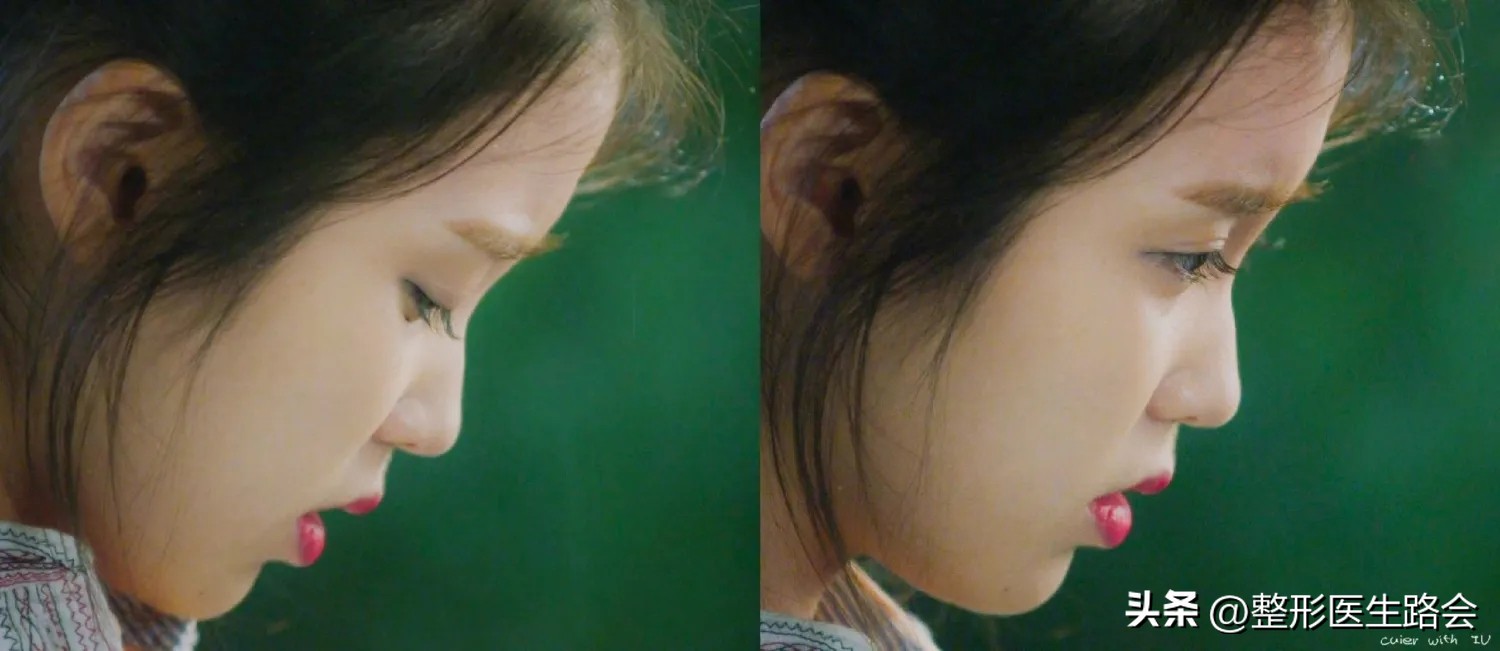 塌鼻子做什么样的鼻子安全,塌鼻子应该选择哪种隆鼻