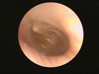 爱耳小知识,爱耳日科普