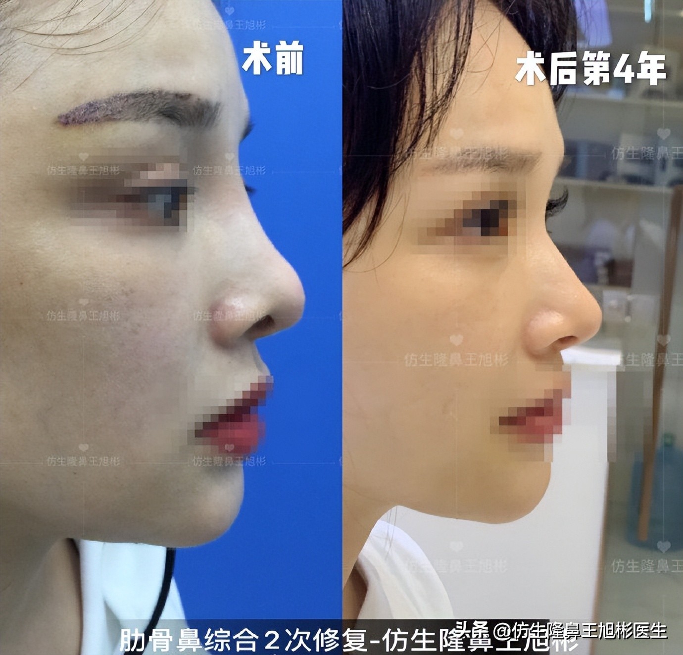 隆鼻的鼻翼怎么修复,隆鼻后多久可以做鼻翼缘矫正