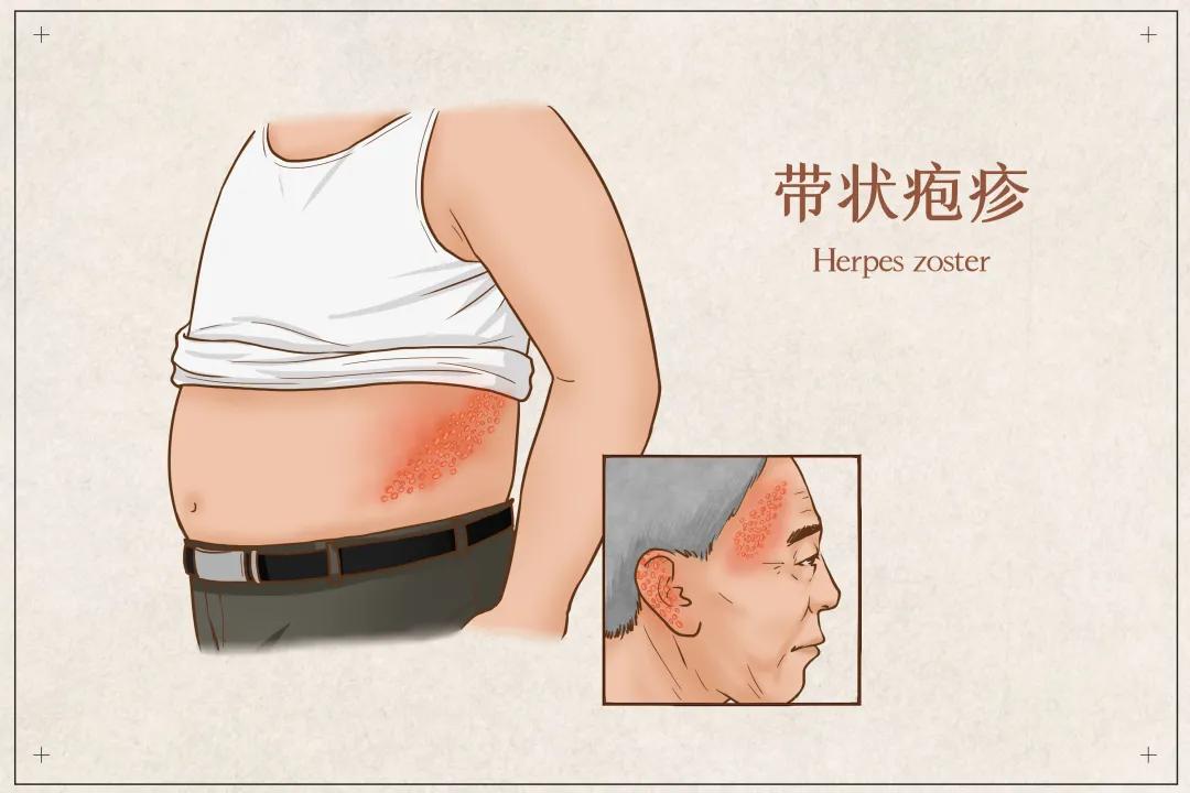 专家提醒这些症状是疾病的征兆,这种疼起来要命的病该怎样避免