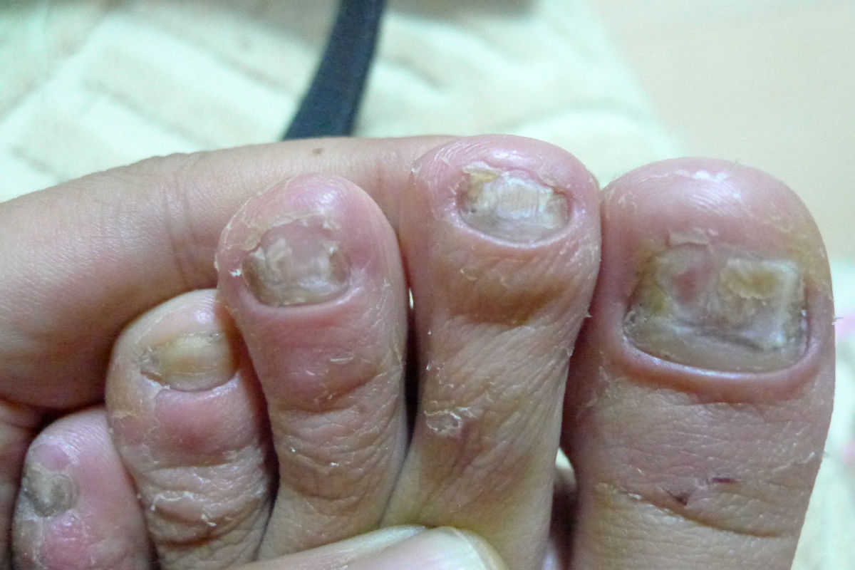 所有的灰指甲,灰指甲的危害到底有多大