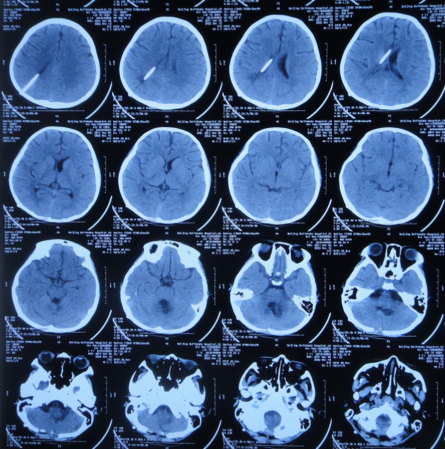 脑干出血儿童,儿童脑干胶质瘤呕吐