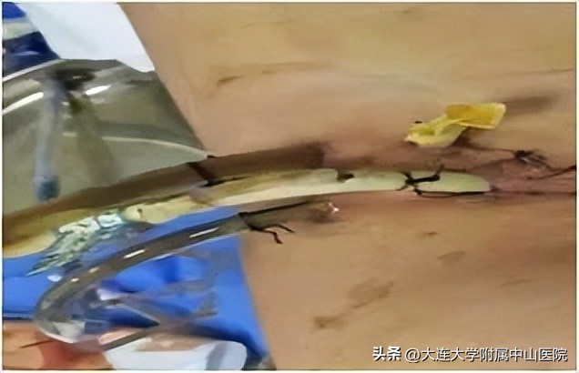 【案例回放】重症急性胰腺炎继发盲肠瘘危及生命，微创手术化险为夷