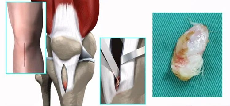 膝盖前面肿了一个包,孩子膝盖上长了一个疙瘩