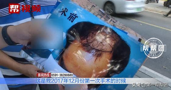 花三万多元植发反被拉低颜值,花一万多块钱植发值不值