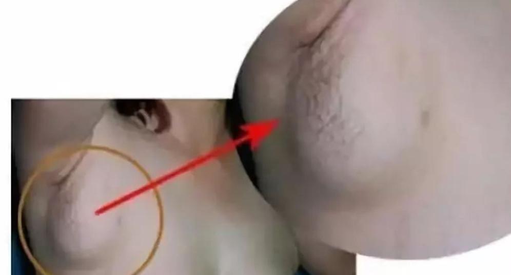 艾滋病腋下肿块,女子洗澡发现腋窝肿块