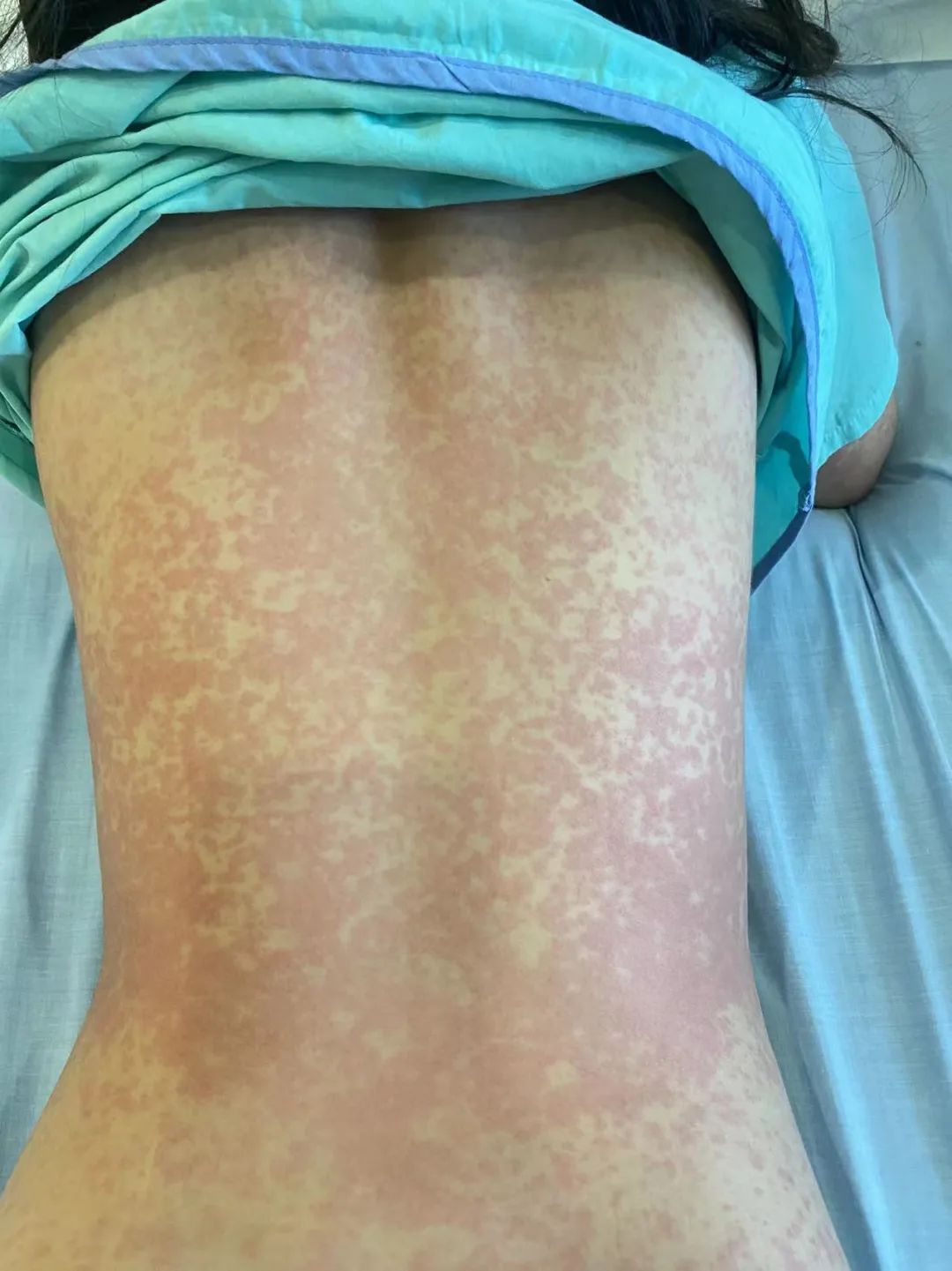 “娃全身红疹，被新加坡医生要求全麻开刀！我该怎么办？”