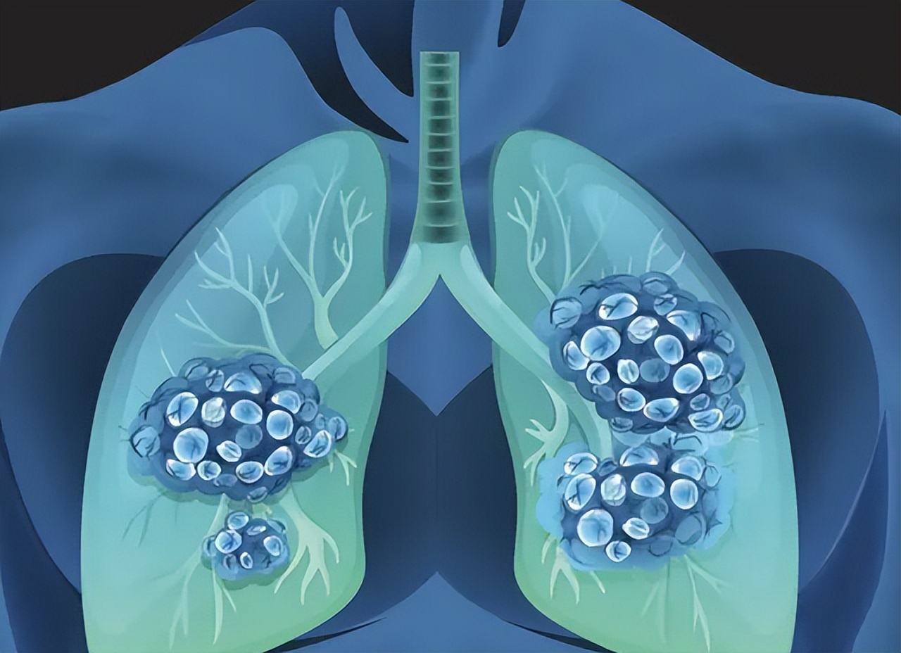 体内有结节哪四种发物不能吃,体内有结节的人尽量少吃4种发物