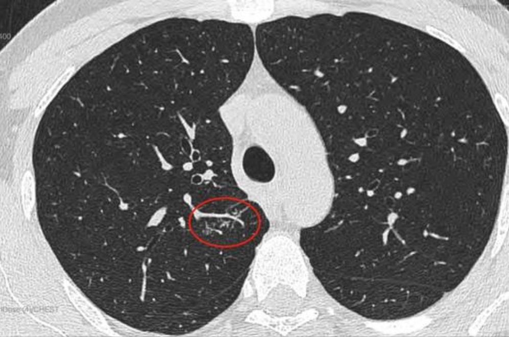 磨玻璃结节9*8mm建议随访,8mm磨玻璃结节一年没长