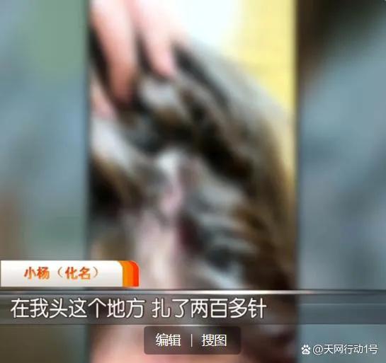 空姐注射玻尿酸出血进医院,空姐注射玻尿酸太阳穴栓塞